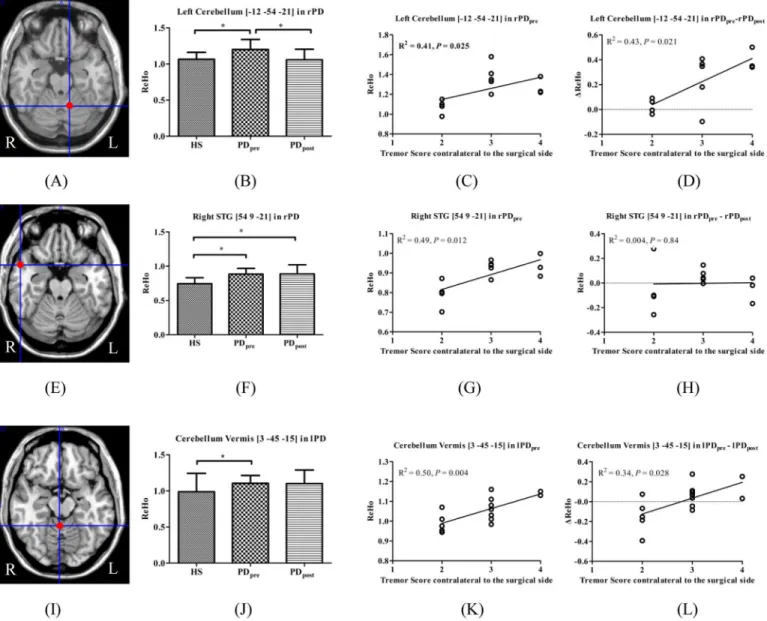 Fig 3. Brain areas which demonstrated altered ReHo relative to HS and correlated with tremor