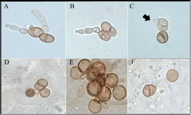 Figura 9.Comparação de células muriformes induzidas com as células muriformes de exame micológico  direto