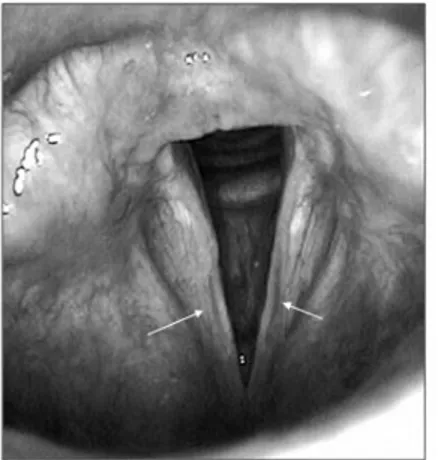 Figure 3. Bilateral sulcus vocalis (case 2, arrows). Videolaryngoscopic examination.
