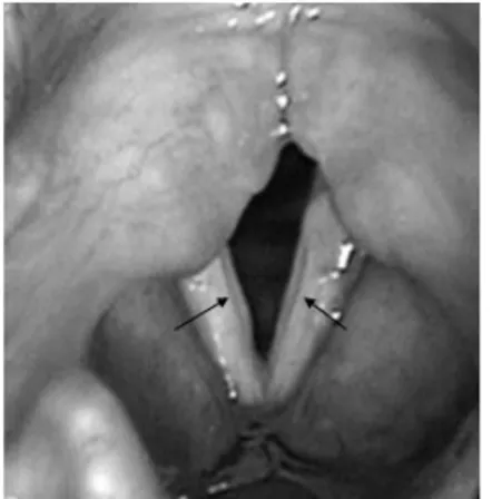 Figure 4. Bilateral sulcus vocalis (case 3, arrows). Videolaryngoscopic examination.