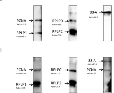 Fig 5. Immunoblot analyses of CSF and serum specimens validated the 5autoantigens. The purified recombinant proteins were resolved viaSDS-PAGE, transferred to a PVDF membrane, and subjected to western blot with (A) CSF and (B) serumspecimens