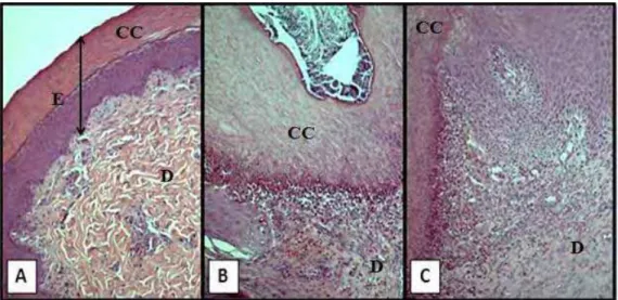 Figura 3. Fotomicrografia do coxim plantar de frangos de corte aos 42 dias de  idade. A) Escore 1 (sem lesão), B) Escore 2 (lesão inicial) e C) Escore 3 (lesão  severa)