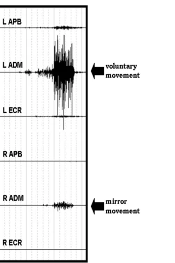 Fig 1. example of mirror movement in the right ADM during voluntary movement of the contralateral homologous muscle in a control subject.