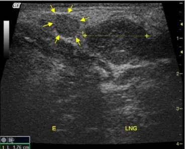 Figure  1.  Oblique  longitudinal  ultrasonographic  image  illustrating  the left  mandibular salivary  gland  (between  calipers),  which  measured  approximately  1.76  cm  long,  with  a  slightly  heterogeneous  echotexture  and  a  decreased  echogen