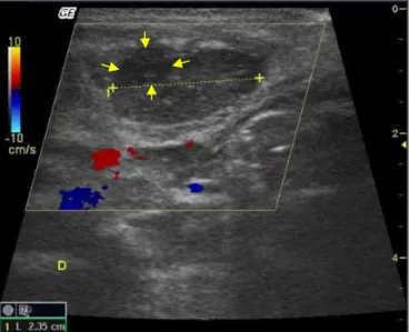 Figure  2.  Transversal  sonographic  illustration  demonstrating  the  hypoechogenic  area  (between  arrows),  suggestive  of  abscess,  with  partially  defined  limits,  measuring  approximately  0.65  cm  diameter, in the medial region of the right ma