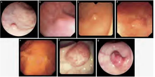 Figura   8   -­‐   Pólipos   em   imagens   de   colonoscopia   (adaptado   de   [15])