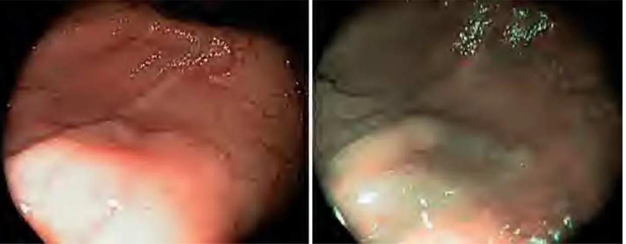 Figura    10    -­‐    Aparência    endoscópica    de    um    SSA:    Usando    luz    branca    (à    esquerda),    usando    NBI    (à    direita)   (retirado   de   [12])