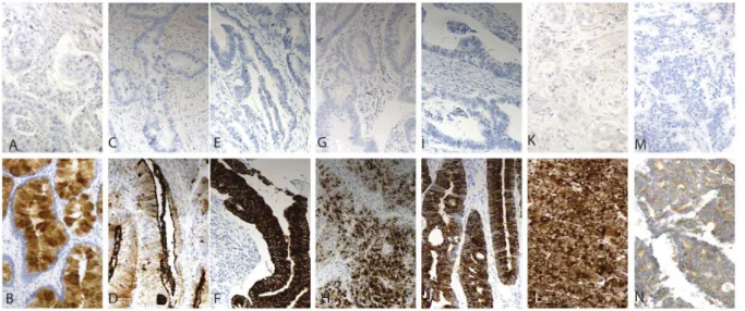 Figure 1. Immunohistochemical staining patterns of the antibiodies studied. Representative images of antibody stainings in colorectal cancer; REG4-negative and -positive (A &amp; B), MUC1- negative and -positive (C &amp; D); MUC2-negative and -positive (E 