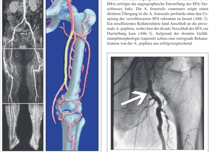 Abbildung 1: MR-Angiographie, bds. SFA-Verschluß, Zielgefäß linke Arterie Abbildung 2: Proximaler Verschluß der A