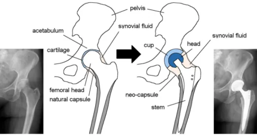 Figure 1. Hip articulation system; natural joint (left); total hip replacement (THR) (right).