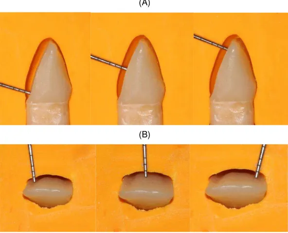 Figura 5 - A) Posicionamento da matriz de silicone para controle da redução do preparo  no  sentido  cervico/incisal;  B)  Posicionamento  da  matriz  de  silicone  para  controle  da  redução do preparo no sentido mesio/distal