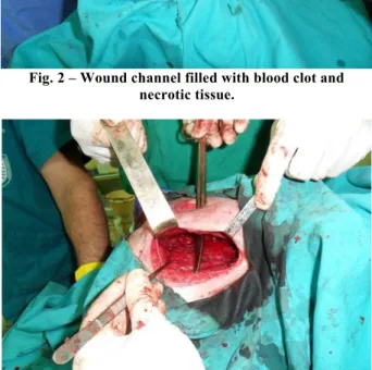 Fig. 5 – After wound revision a drain was placed and fibrin  glue with antibiotics applied