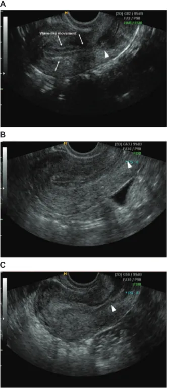 Fig 1: Ultrasound images of endometrium. Echogenisity was  decided by the comparison of myomertial echo