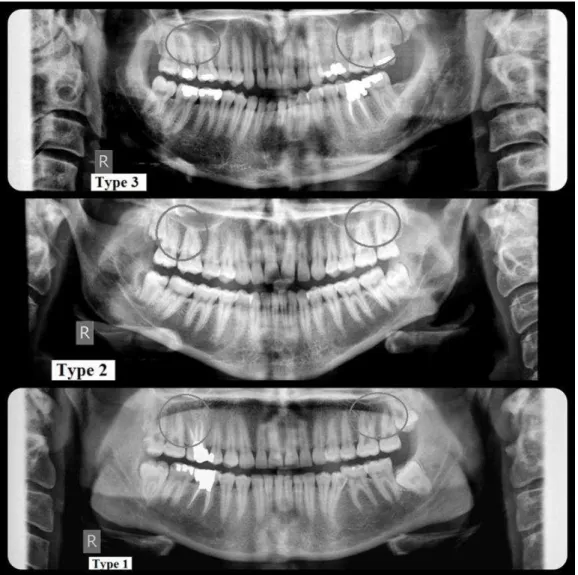 Figure 1. Panoramic radiographs demonstrating types 1, 2, and 3 of root tip to sinus floor relationship