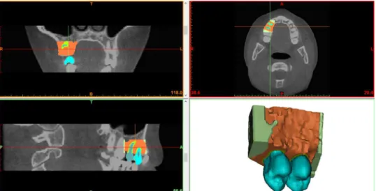 Figure 1: Pre-selected premolar teeth and bone structure used in this work for building the numerical model
