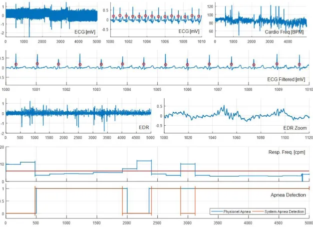 Figure 3. Example of QRS detection (red dots), ECG-derived respiration (EDR) extraction and apnea detection from Physionet’s ECG signal