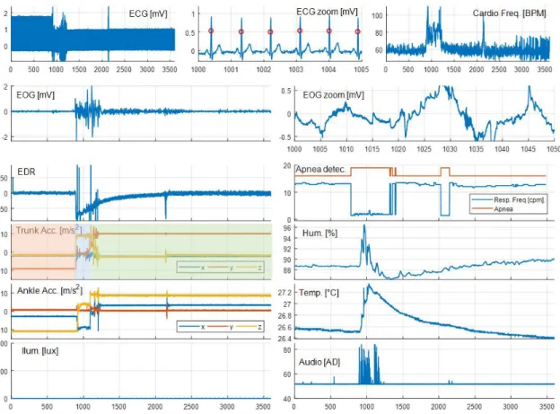 Figure 6. EOG signal comparison of 100 seconds of sleep for a single individual and at different moments in the same night