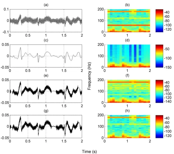 Figure 4. (a) Raw ECG record 1105115 and (b) its spectrogram. Denoised ECG signal obtained by (c) proposed method, (e) thresholding technique  and (g) notch filter and their spectrograms (d), (f) and (h), respectively.