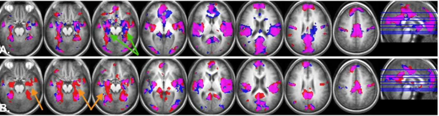 Figure 3. Brain regions showing significant positive correlation between the duration of nocturnal hypoxemia and effects of task load in DMN (ie, regions where increased duration of nocturnal hypoxemia correlates with less effective  deactiva-tion of DMN r