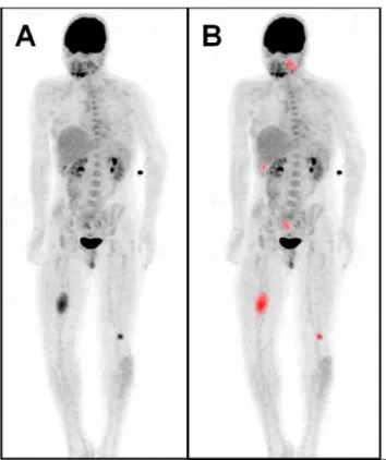 Fig 5. Multiple metabolically active tumors. Maximum intensity projection PET image (A) of a patient with a MPNST in the right upper leg (SUV max / MTV / TLG: 5.3 / 63488 / 190464), plexiform neurofibromas in the left head and neck area (SUV max / MTV / TL