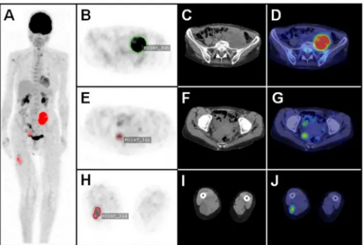 Fig 1. Automated 3D-segmentation and volumetric assessment of nerve sheath tumors. Maximum intensity projection PET image (A) with automatically delineated metabolically active tumors (red)