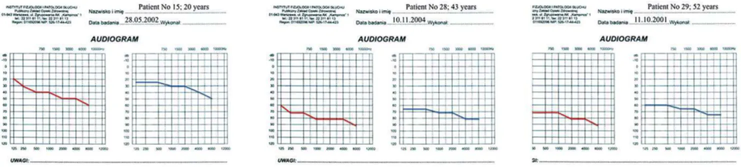 Figure 1. Audiograms of patients 15, 28, and 29 when first diagnosed with isolated hearing impairment.