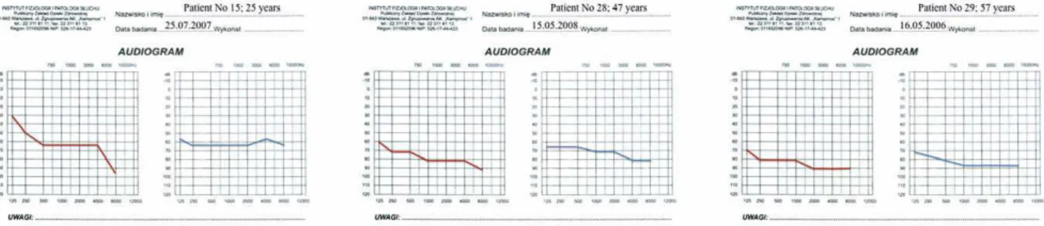 Figure 3. Latest audiograms of the three patients shown in Figs. 1 and 2. Patients 15 and 29 have become cochlear implant users