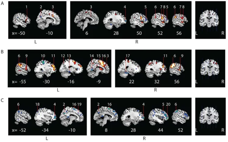 Figure 1. Cerebral activation patterns during movement execution in the affected hand for patients versus normal controls and patients versus feigners