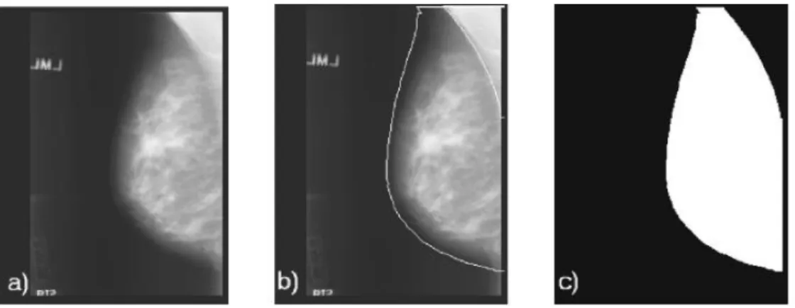 Figura 3.2 – (a) Exemplo de mamogramas usado no trabalho. (b) Mama com o limite e  o  músculo  peitoral  detectador