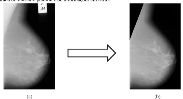 Figura 5.6  – Banco mini-MIAS: exemplo de imagens pré-processadas das três classes  de densidade mamária