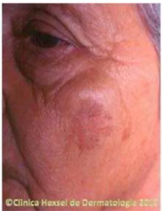 Figura 5: Queratose Actínica 