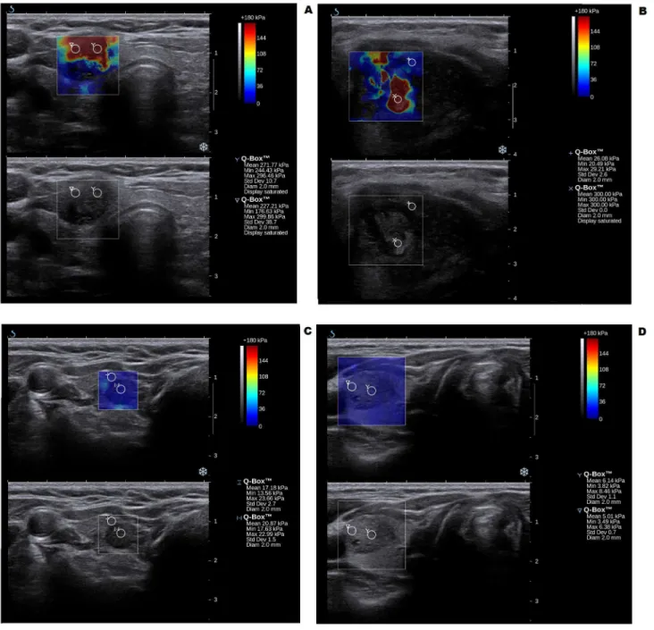 Figure  1.    Conventional  ultrasonography  and  elastography  of  papillary  thyroid  carcinoma  (A),  anaplastic  thyroid carcinoma (B) and two colloid nodules (C, D)