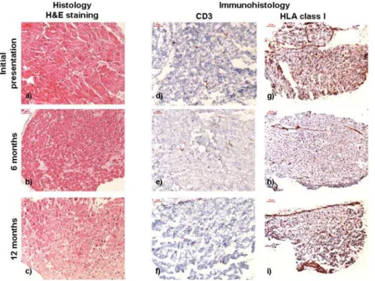 Figure 1. Histological (a, b, c) and immunohistological (d–i) stainings (CD3: d–f; HLA class I expression: g–i) of the EMBs at the initial presentation, at 6 and 12 months follow-up