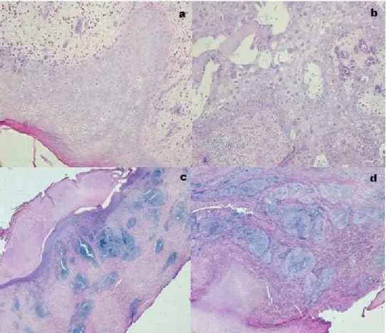 Figura  1a  -  Hiperplasia  do  tecido  epitelial  H&amp;E  x20.  Figura  1  b  –  Células  com  degeneração  hidrópica,  vacuolização  e  presença  de  corpúsculos  de  inclusão  intracitoplasmáticos  eosinofílicos  H&amp;E  x20