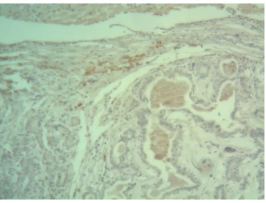 Figura  8.  Fotomicrografia  de  carcinoma  em  tumor  misto  I,  imunorreativo  para  marcação de CD3
