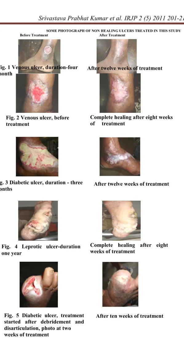Fig. 1 Venous ulcer, duration-four  month 