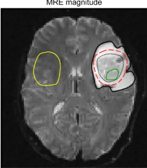 Figure 1. Example illustrating how the regions of interest (ROI) are defined one slice of the MRE magnitude image of patient