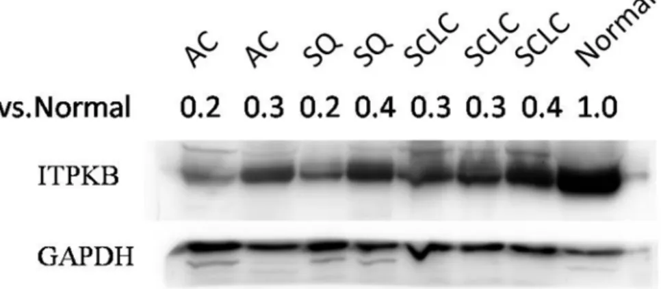 Fig 4. Expression of ITPKB protein in 3 lung carcinoma subtypes. Western blot was used to detect the expression of ITPKB protein in lung carcinoma tissues (2AC samples, 2SQ samples, 3SCLC samples) and adjacent normal lung tissue