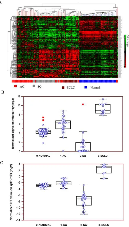 Fig 1. Expression profiles of miR-375 in 3 lung carcinoma subtypes. A, Hierarchical clustering of miRNA expression profiles in AC, SQ, SCLC and normal lung tissue on microarrays
