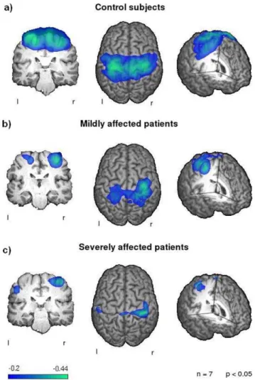 Figure 1. Event related desynchronization. Changes in the beta- beta-frequency-band during swallowing execution compared to the resting stage