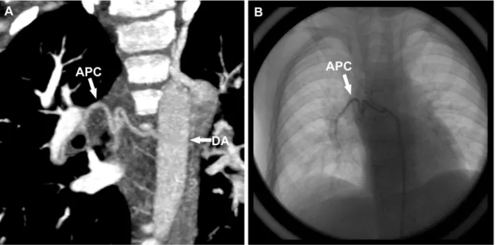 Figure 7. A 3.4-year-old boy underwent low-dose PGA scanning with 80 kV and 106 mAs/rot (effective dose, 0.44 mSv)