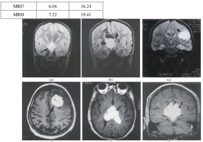 Figure 3. Original abnormal mass MRI brain images: (a) MRI3, (b) MRI4, (c) MRI5, (d) MRI6, (e) MRI7, (f) MRI8