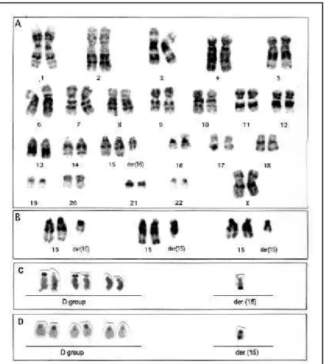 Fig 1. Complete (A) and partial (B) GTG-band- GTG-band-ing karyotypes. Partial karyotypes showGTG-band-ing the D- group chromosomes: (C)  AgNOR-banding showing a single satellite  extend-ing from the long-arm end in the extra  chro-mosome; (D) CBG-banding 