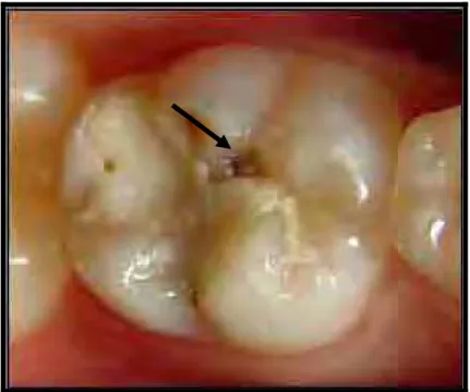 FIGURA 27-   Dente 85 apresentando defeito marginal  da restauração maior que 0,5 e menor  que 1,0mm associado à ocorrência de  lesão cariosa aos 6 meses - escore 2 