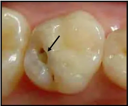 FIGURA 31-   Dente 65 apresentando perda parcial da  restauração no sulco ocluso-palatino aos  12 meses- escore 4 