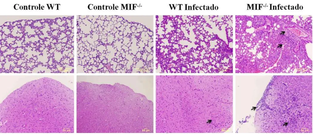 Figura 5. A ausência de MIF agrava o quadro inflamatório observado no pulmão, fígado e cérebro de camundongos durante a infecção  por Neospora caninum