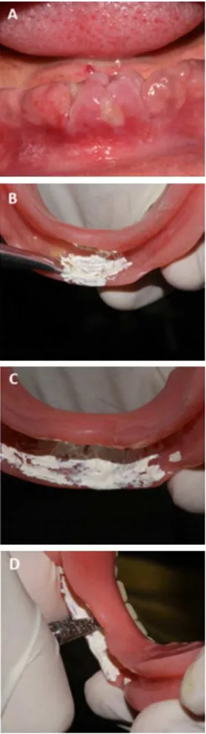 Figura  8  –  (A)  ulceração  na  região  vestibular  do  rebordo devido  à  compressão  da  base  protética;  (B)  pincelando  pasta branca  da  pasta  zinco  eugenólica  para  determinação  da  área de  compressão;  (C)  verificação  da  área  de  compre
