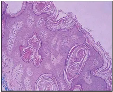 Figura 4 – Corte Histológico de Queratose Seborreica. Presença de acantose,  hiperqueratose e pseudocistos córneos – Hemoloxilina Eosina,10x