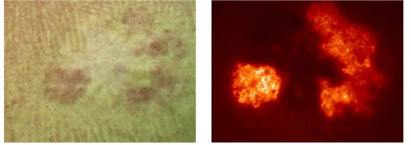 Figura 5 – Imagem de um carcinoma sem (esquerda) e com (direita) a aplicação de laser  capaz de induzir a fluorescência da protoporfirina IX 