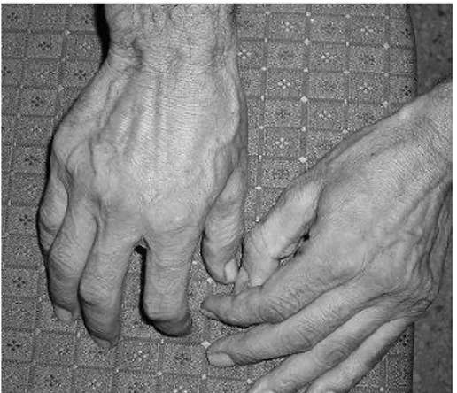 Figure 1. Striatal hand deformity in Parkinson’s disease patient.